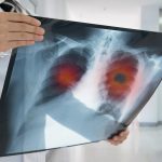 Cancer du poumon radiographie