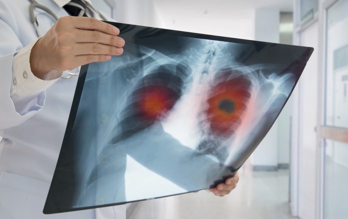 Cancer du poumon radiographie