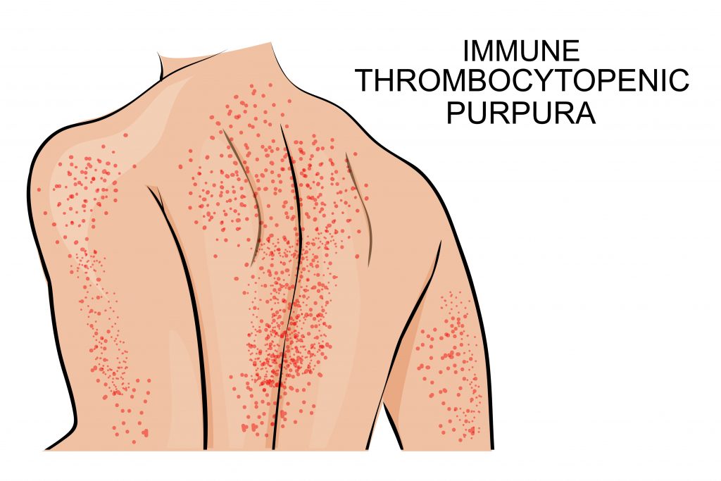 Purpura thrombopénique immunologique