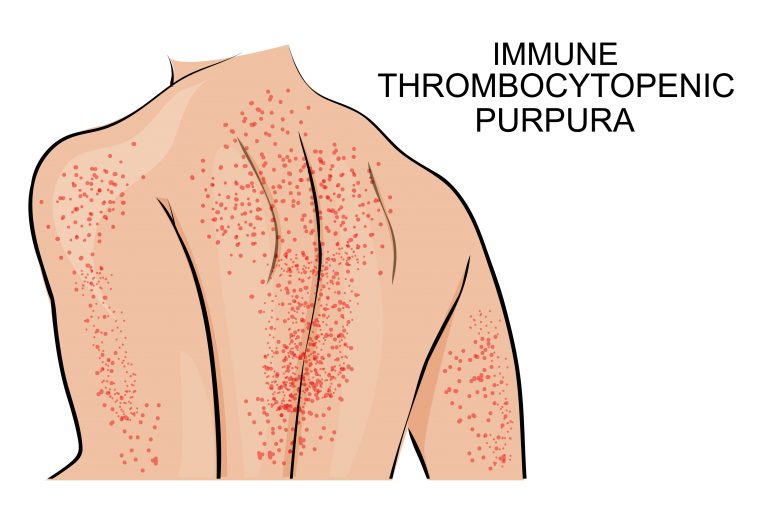 Le Purpura thrombopénique immunologique