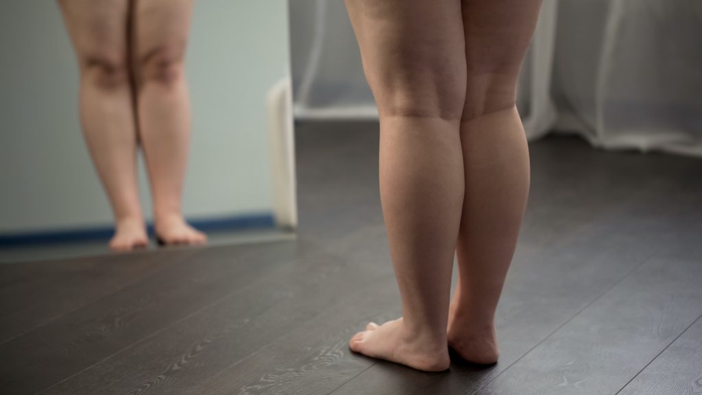 obésité : jambe en surpoids devant le miroir