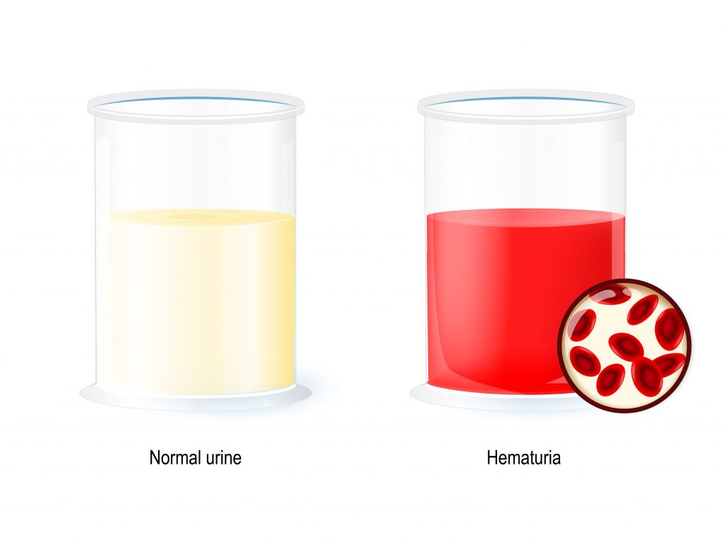 hématurie : comparaison avec urine normale