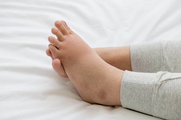 Syndrome œdémateux : pied gonflé