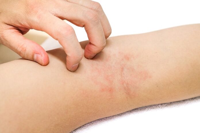 Quels sont les signes d'une allergie ? urticaire