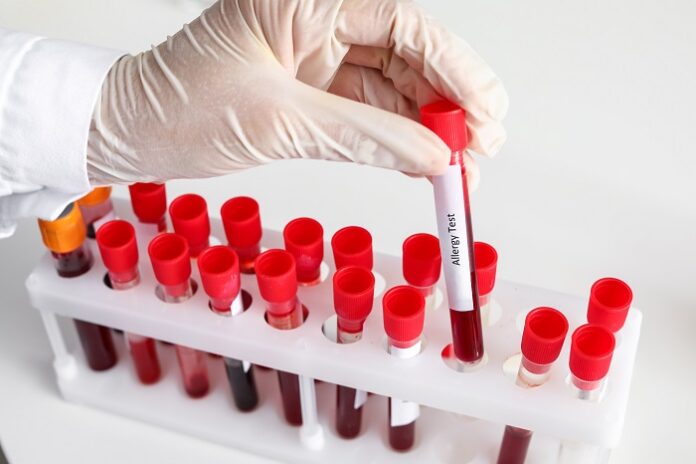 Comment savoir si l’on est allergique  : test sanguin
