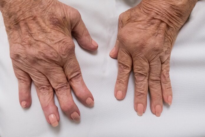polyarthrite rhumatoïde : mains
