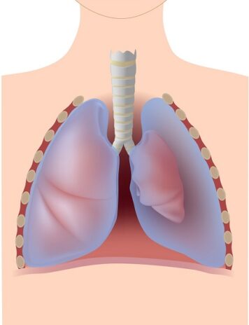 pneumothorax : radiographie