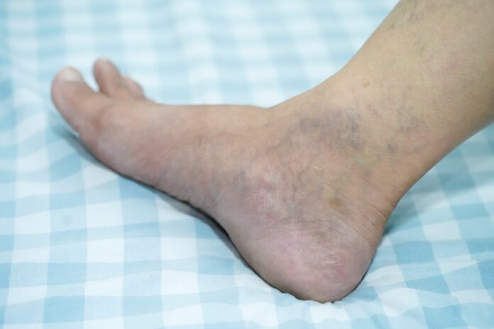 Varices et insuffisance veineuse : pied et cheville