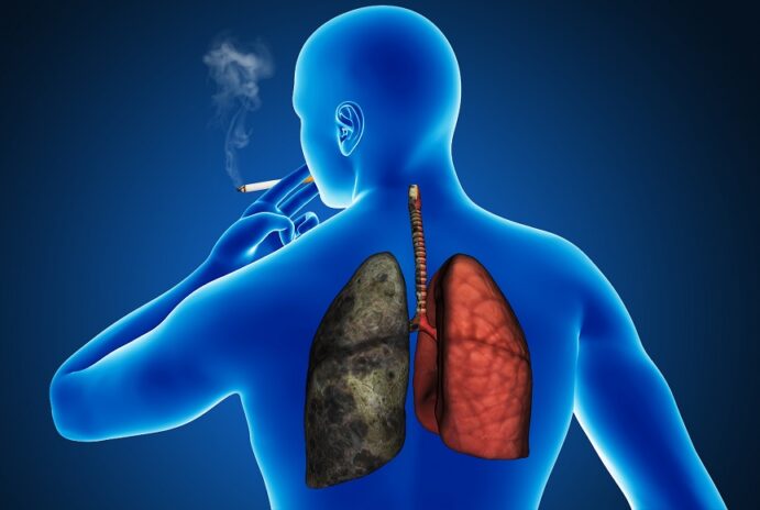 Cancer du poumon : cigarette