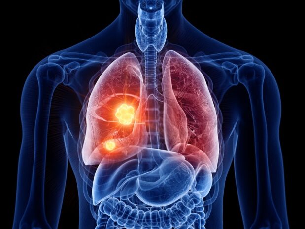 Cancer du poumon : corps