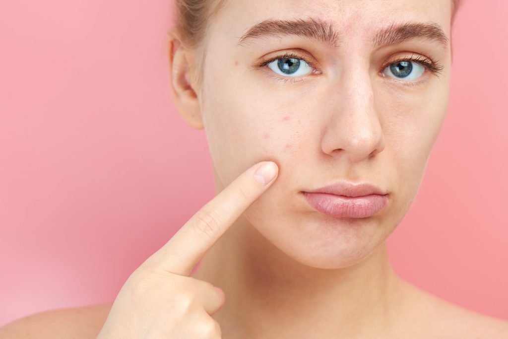 Bien-être : Top 5 des idées reçues sur l’acné