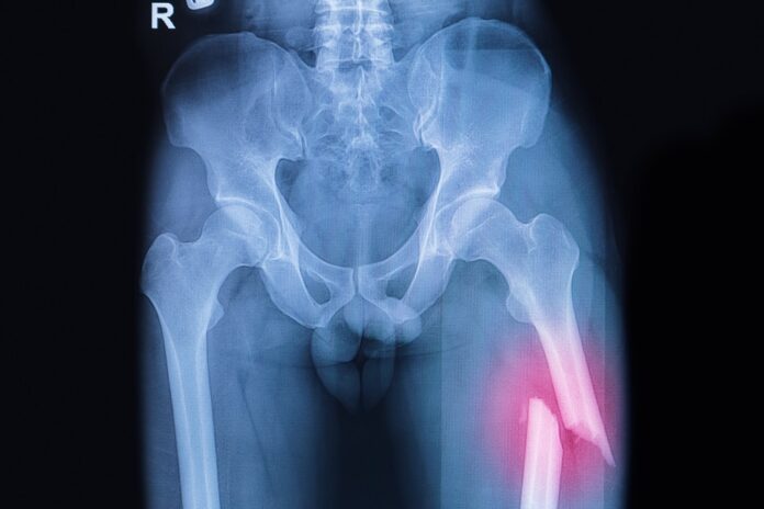 fracture-du-col-f-moral-anatomie-causes-la-sant-au-quotidien