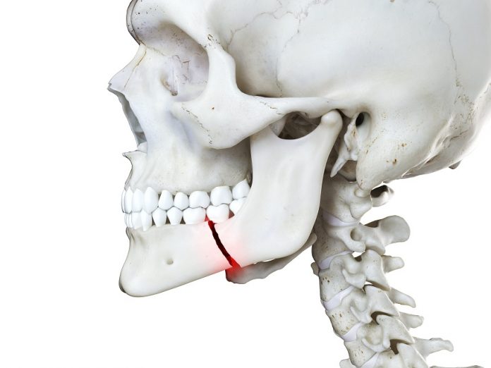 Fractures Mandibulaires : squelette