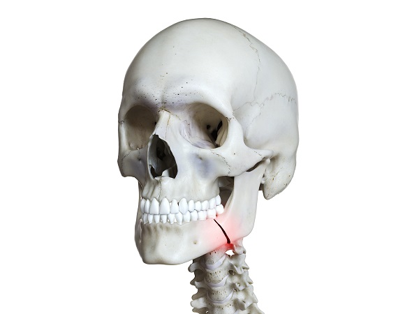 Fractures Mandibulaires : squelette crânien menton