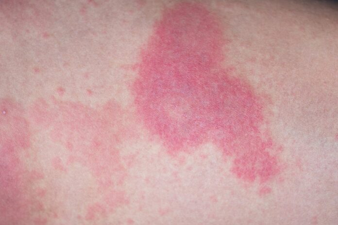 rysip le Sympt mes Causes Et Traitements La Sant Au Quotidien rysip le Sympt mes Causes Et Traitements La Sant Au Quotidien