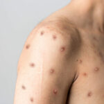 Trois cas de variole du singe en France : faut-il s’attendre à plus de cas ?