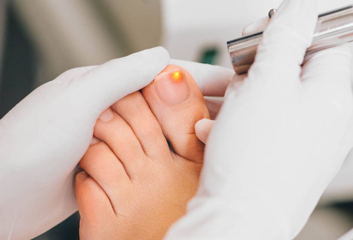 Mycose de l'ongle de pied : diagnostic, symptômes et traitement - La Santé  Au Quotidien