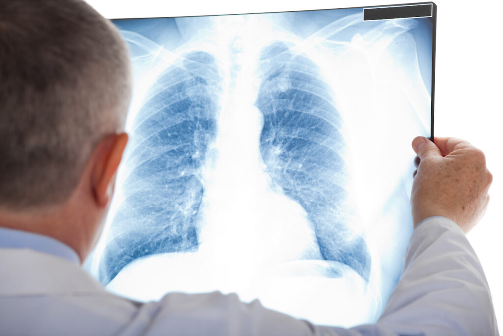 Cancer des poumons : en serez-vous victime dans 10 ans ?