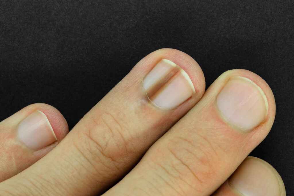 Cancer de la peau comment reconnaître un mélanome sous l’ongle ? La — free download