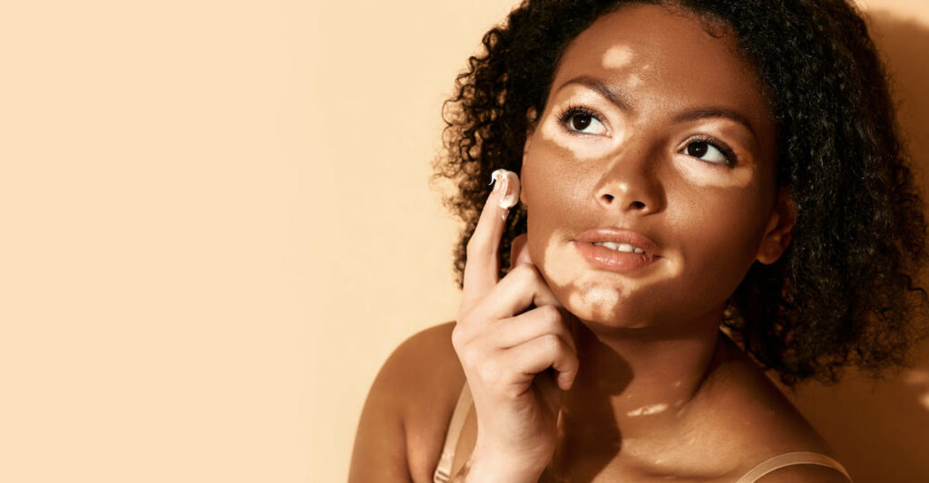 Peau : un traitement prometteur contre le vitiligo