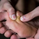 5 remèdes naturels pour soigner les cors aux pieds douloureux
