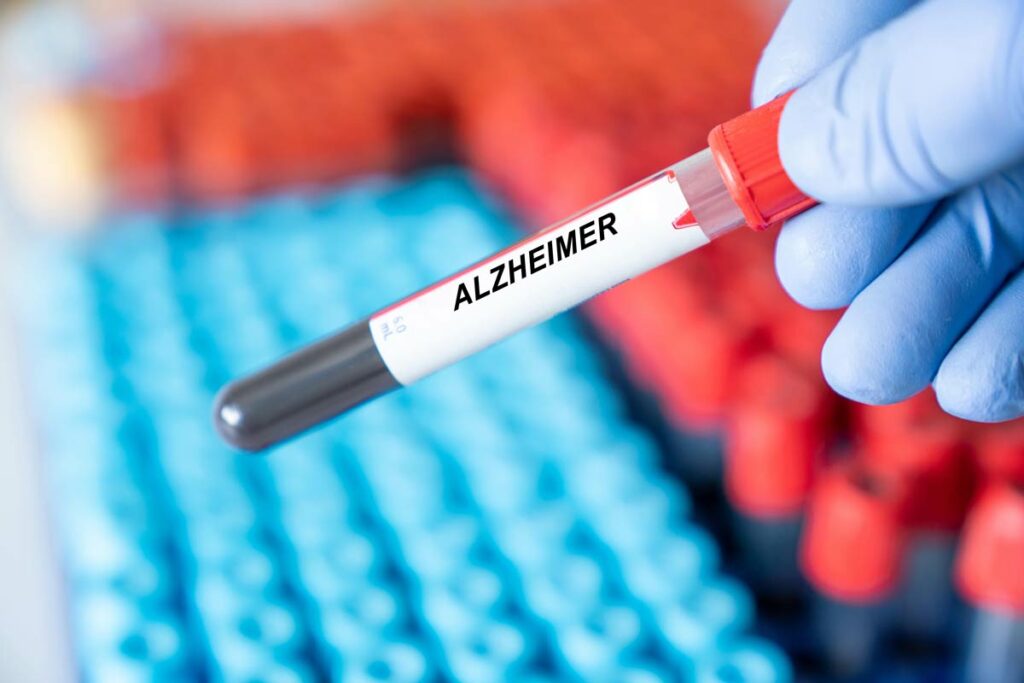 Alzheimer : le sang menstruel pourrait aider à traiter la maladie.