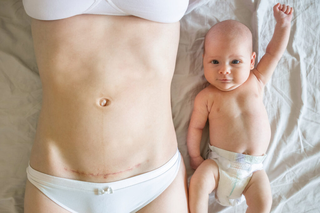 Naissance : quel est l’effet de la césarienne sur le microbiote de bébé ?