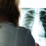 Signes embolie pulmonaire
