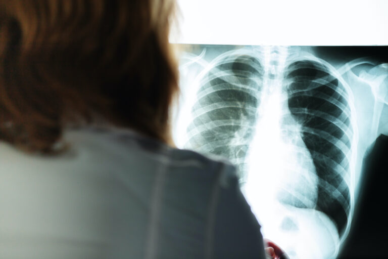 Embolie pulmonaire : les premiers signes à reconnaître qui doivent vous inquiéter