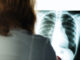 Signes embolie pulmonaire