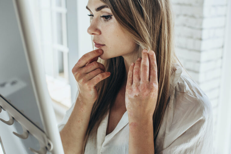 Eczéma : ces aliments à éviter - La Santé Au Quotidien