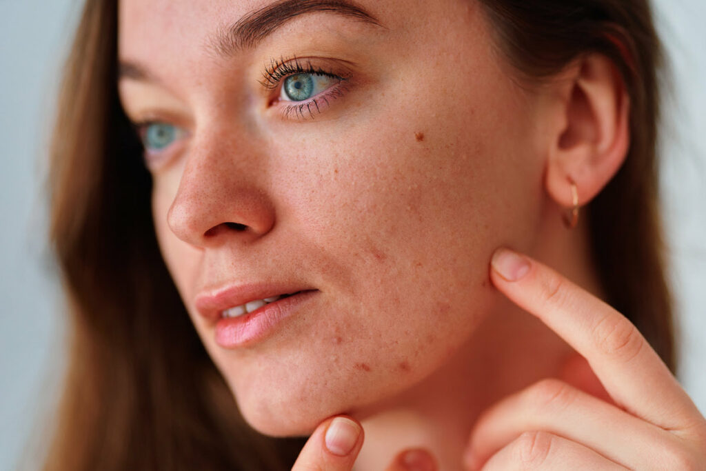 L’acné est bonne pour la santé, affirme une étude