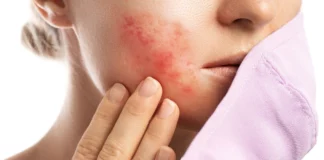 Allergie aux anti-inflammatoires stéroïdiens ! Quels sont les signes annonciateurs à reconnaître ?