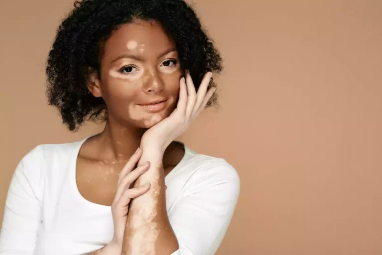 Vitiligo : un premier traitement autorisé  très attendu