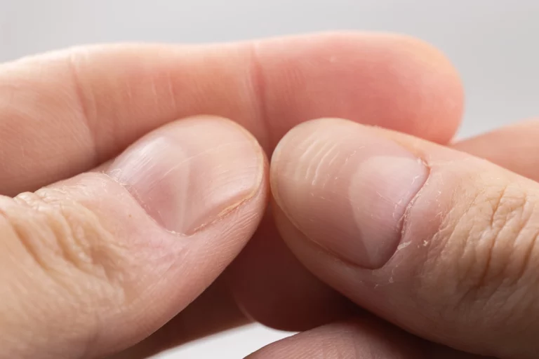 Vous avez des ongles striés Ce signe n'est pas normal