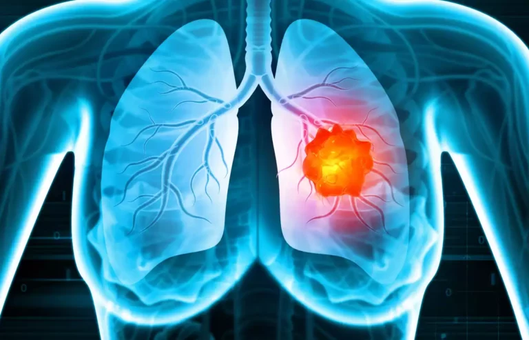 Cancer du poumon : un traitement prometteur contre les formes agressives