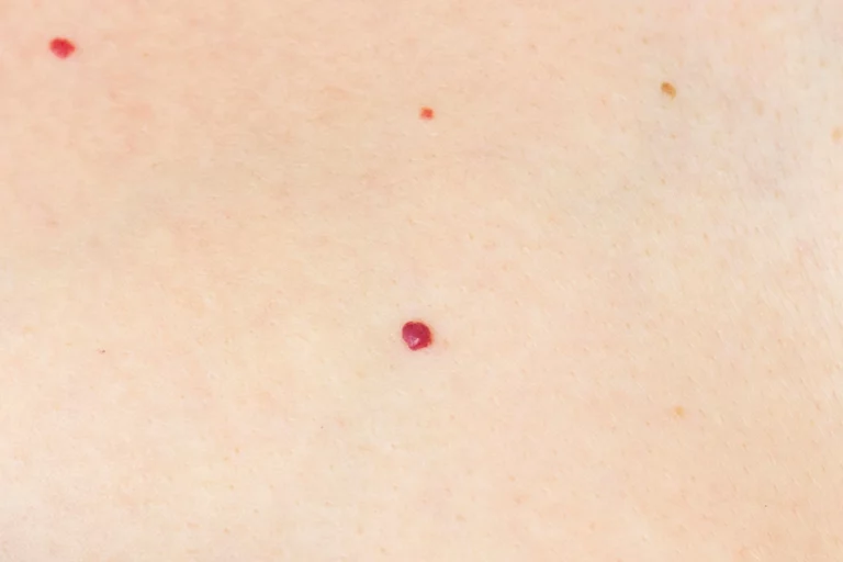 Angiome rubis ou pétéchie : tout savoir sur les petits points rouges sur votre peau.