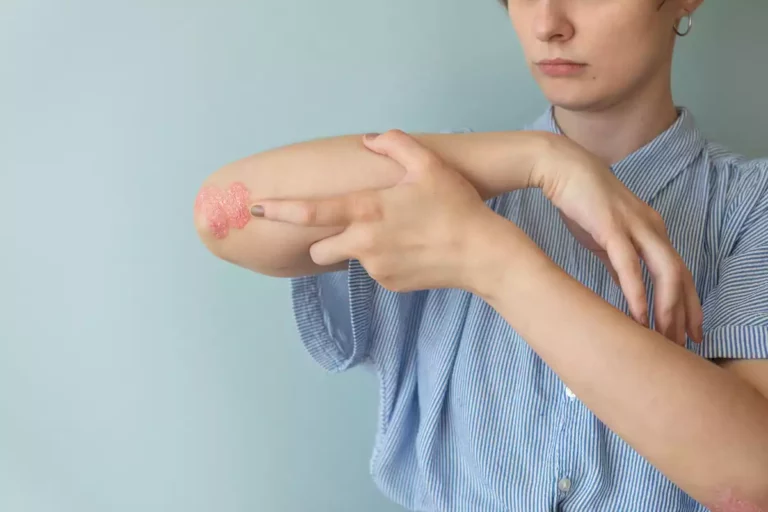 Psoriasis: espoir pour un nouveau traitement grâce à une découverte française