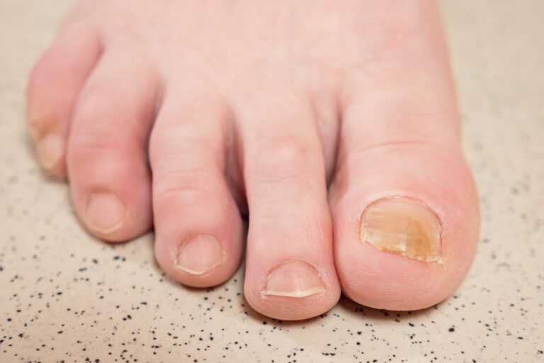 Ongles-jaunes-malades