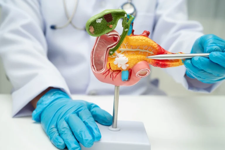 Cancer du pancr&eacute;as