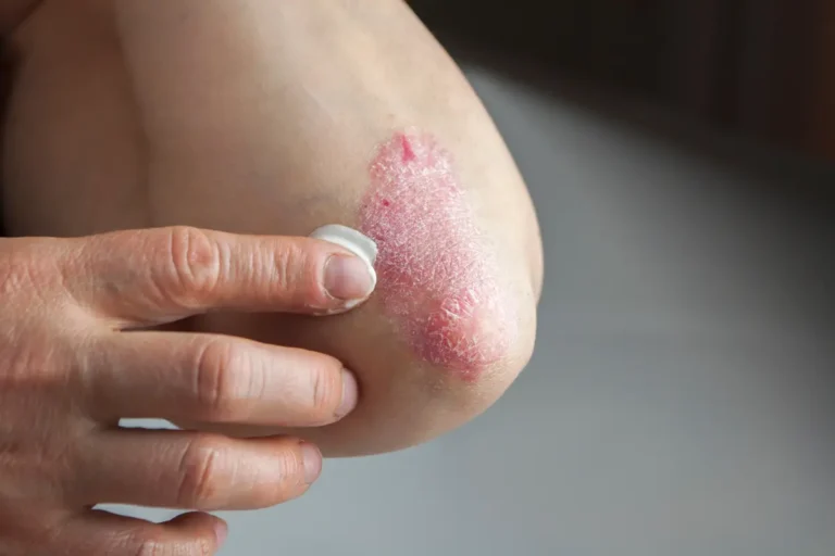Votre peau pourrait elle-même aggraver cette maladie, voici comment Psoriasis
